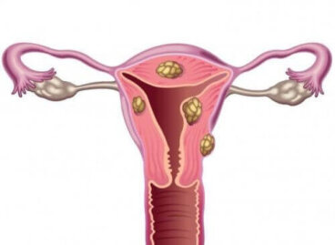 Les fibromes utérins et l'infertilité