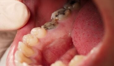 Dentinogenèse imparfaite : tout ce que vous devez savoir