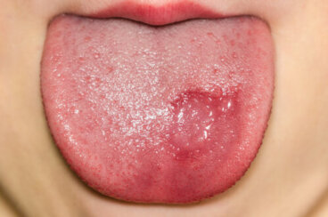 Comment savoir si mon enfant a des mycoses sur la langue ?