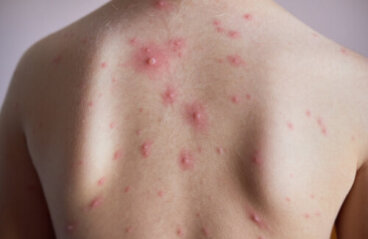 Comment prévenir et traiter les marques de varicelle