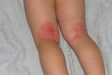 Érythrodermie chez les enfants : symptômes, causes et traitements