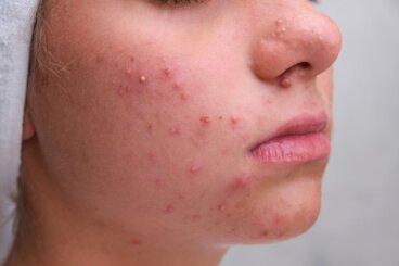 Comprendre l’acné chez les adolescents